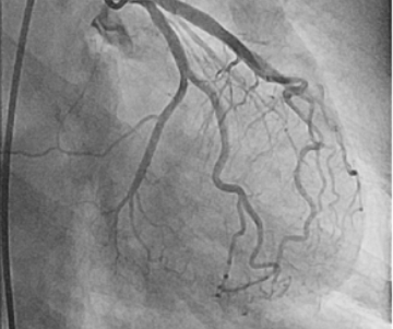 You are currently viewing Safe Transfer of Patients with Suspected Myocardial Infarction to Facilities with Cath Labs