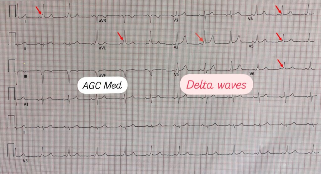 Wolff-Parkinson-White Syndrome: What You Don’t See Can Hurt Them – AGC MED